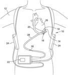 CIRCULATORY SUPPORT SYSTEMS INCLUDING CONTROLLER AND PLURALITY OF SENSORS AND METHODS OF OPERATING SAME