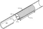 Stent designs to cover catheter access site