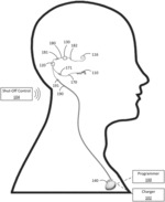 COCHLEAR IMPLANT SYSTEM WITH IMPROVED INPUT SIGNAL-TO-NOISE RATIO