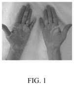Medicinal composition, method of manufacture, and method for treating skin ailments such as palmar-plantar erythrodysesthesia