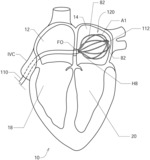 Systems, Devices, Components and Methods for Detecting the Locations of Sources of Cardiac Rhythm Disorders in a Patient's Heart Using Improved Electrographic Flow (EGF) Methods