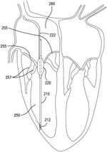 Inflatable transcatheter intracardiac devices and methods for treating incompetent atrioventricular valves