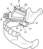 Bite block with a needle alignment attachment system