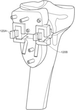 Surgical assembly, stabilisation plate and methods