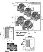 SYSTEM, METHOD AND COMPUTER-ACCESSIBLE MEDIUM FOR TRANSCRANIAL MAGNETIC STIMULATION TREATMENT OF NEUROPSYCHIATRIC DISORDERS