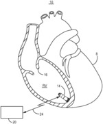 Rate smoothing to enhance atrial synchronous pacing in a ventricular pacemaker