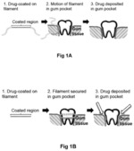 Tailorable medicinally coated floss for the treatment of gum disease