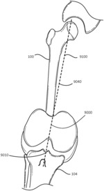 KNEE ARTHROPLASTY ALIGNMENT METHODS, SYSTEMS, AND INSTRUMENTS
