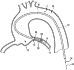 GUIDE CATHETER EXTENSION SYSTEM WITH A DELIVERY MICRO-CATHETER CONFIGURED TO FACILITATE PERCUTANEOUS CORONARY INTERVENTION