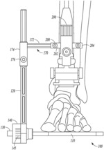 Total ankle external alignment footplate