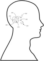 Combination implant system with removable earplug sensor and implanted battery