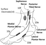 Treatment of pelvic floor disorders using targeted lower limb nerve stimulation