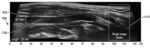 BI-PLANE AND THREE-DIMENSIONAL ULTRASOUND IMAGE ACQUISITION FOR GENERATING ROADMAP IMAGES, AND ASSOCIATED SYSTEMS AND DEVICES