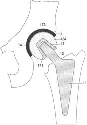 Prosthesis for hip replacement with polyethylene head and anti-rotational intra-prosthetic assembly