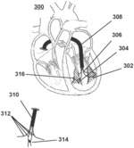 DEVICE FOR IMPROVING CARDIAC FUNCTION